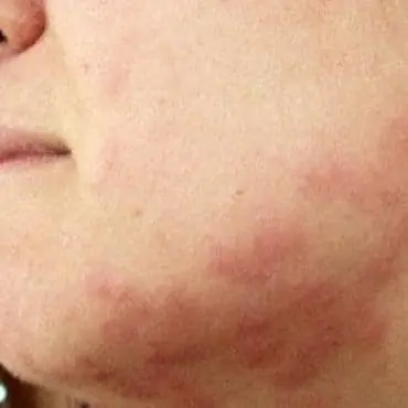 bed-bug-circle3 bed-bug-circle3